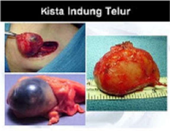 obat herbal stroke